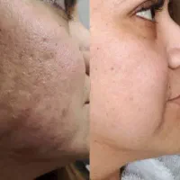 رفع جوش لک در یک ماه