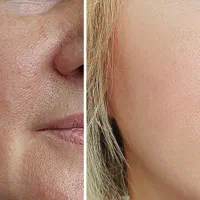 مدل جهت مزوژل جوانساز -بوتاکس