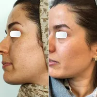 فیشیال پاکسازی و درمان تضمینی پوست|خدمات آرایشگری و زیبایی|کرمانشاه, |دیوار