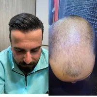 کاشت مو و ابرو شیراز در اراک