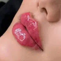 تخفیف ویژه ژل وبوتاکس