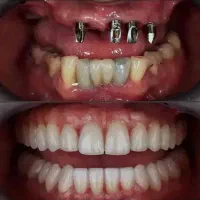 شرایط ویژه دندانپزشکی و ایمپلنت در تبریز