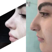 جراحی زیبایی بینی دکتر حجت شکرگزار و کاشت ایمپلنت