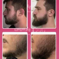 ریش هاتون کم پشته ، با سرم سیر سیاه پرپشتش کن
