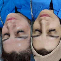 تخفیفات ویژه فیشال تخصصی پوست وکاشت مژه اصولی هیدن