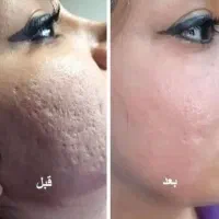 منافذ باز داری جای جوش داری