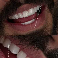 دندان پزشکی.کامپوزیت فکی شش تومن. عصب کشی وترمیمم.