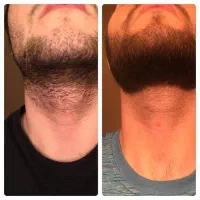 ریش بی تراکم نداشته باش