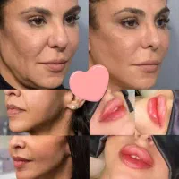 قبل از بوتاکس، فیلر ژل، مزو، prp اگهی رو بخون