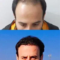 کاشت مو و ابرو،مزو تراپی و پی ار پی