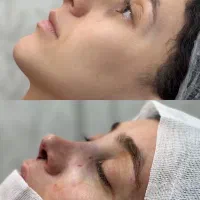 اف  جراحی بینی در کلینیک و بیمارستان اهواز