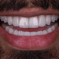 کامپوزیت فکی ۶م.اقساط ایمپلنت دندان پزشکی عصبکشی