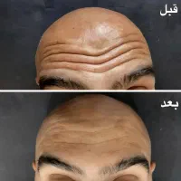 تزریق بوتاکس و آمپول لاغری توسط پزشک