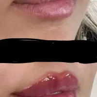 جشنواره عیدانه تزریق ژل و بوتاکس و لاغری در کلینیک