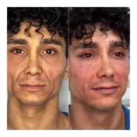 آموزش خدمات بوتاکس فیلر شیراز، کوشک میدان