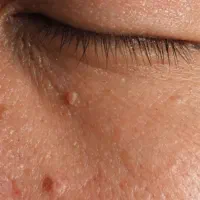 برداشتن منگوله و خال های پوستی