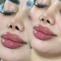 تزریق ژل و بوتاکس متریال با کیفیت