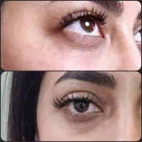 آفر باورنکردنی برطرف کردن گودی و تیرگی زیر چشم