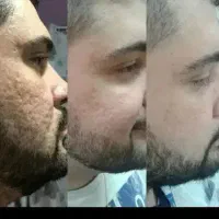 درمان فوری جای جوش و رد آکنه توسط پزشک|خدمات زیبایی و سلامت|مشهد, احمدآباد|دیوار
