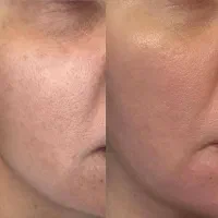 تخفیف ویژه فیشال (پاکسازی صورت)