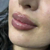 فیلر ژل لب ام تکنیک عروسکی باربی روسی - دکتر واحدی