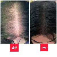 رفع ریزش مو و رویش مجدد تضمینی