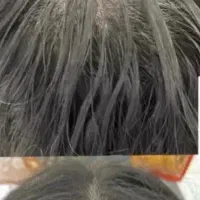 اسکراب اسکالپ و ضخیم سازی ساقه مو تخصصی