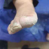 کراتوز تراپی پا آفر تمدید شد.