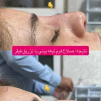 مطب لیزر بلفارو غبغب ژل لب