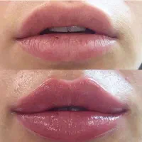 جشنواره ژل و بوتاکس و لیزر موهای زاید در نارمک