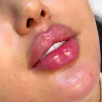 تزریق تخصصی ژل و بوتاکس در هشتگرد