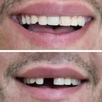 دندانسازی ،دندان مصنوعی،مشهد