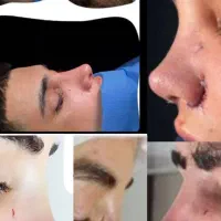 جراحی بینی فقط ۳۰ میلیون