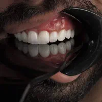 جشنواره  دندان کامپوزیت لمینیت روکش عصب IPS IMAX
