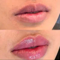 تزریق ژل و بوتاکس