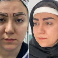 کاشت ابرو فقط ۱۴ میلیون بلفاروپلاستی آموزش