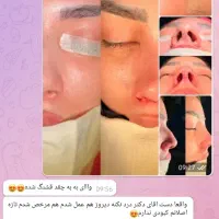 جراحی زیبایی بینی توسط متخصص گوش حلق بینی