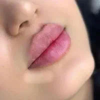 لیفت پوست و جوانسازی تزریق لب ،چونه،گونه،خط خنده