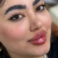 آموزش ژل و بوتاکس