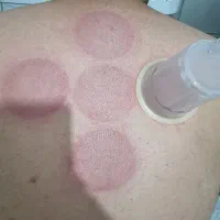 حجامت و بادکش