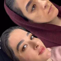 مدل بوتاکس و فیلر لب