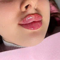 ژل لب هایفولیفت نخ زاویه چانه بوتاکس فیلربینی لیزر