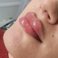 بوتاکس،ژل،لیزر موی زائد،خالبرداری،مزوتراپی