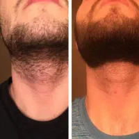 ریش و پشماتو تضمینی در ببار