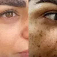 برای همیشه از شر لک هات خلاص شو