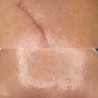 رفع ترک های شکم و بدن