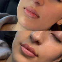 جشنواره ویژه تزریق ژل و مزو و پی آرپی درمطب|خدمات زیبایی و سلامت|اصفهان, نقش جهان|دیوار