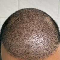 کاشت مو شرایط ویژه