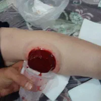 ح. جامت بهاره فصدخون و بادکش