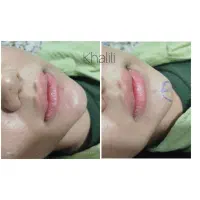 آموزش ژل وبوتاکس باقیمت مناسب
